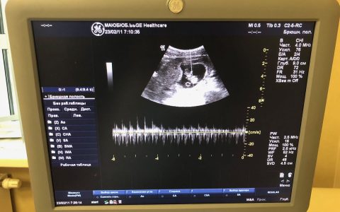 俄罗斯代妈成功妊娠，一大早收到好消息，胚胎生长发育良好！B超检查胚胎直径8毫米，怀孕4-5周